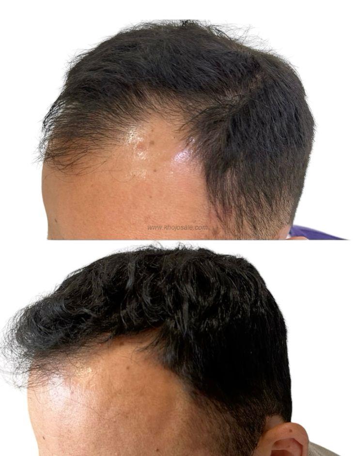 AHLAWAT HAIR TRANSPLANT COSMETIC JIND HARYANA