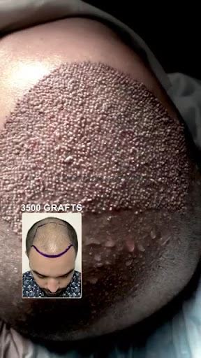 Clinic Derma Hair Best Hair Transplant And Laser Skin Treatment Center