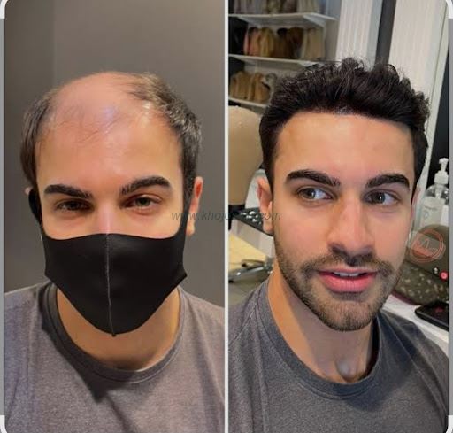 Hair Patch Service New Patch Sector 52 Wazirabad Gurgaon