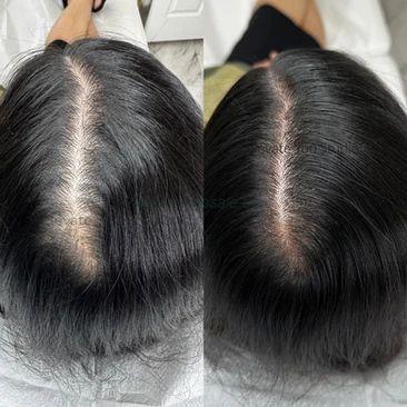 Hair Patch Services In Udaipur