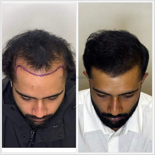Profile Forte Best Hair Transplant In Ludhiana