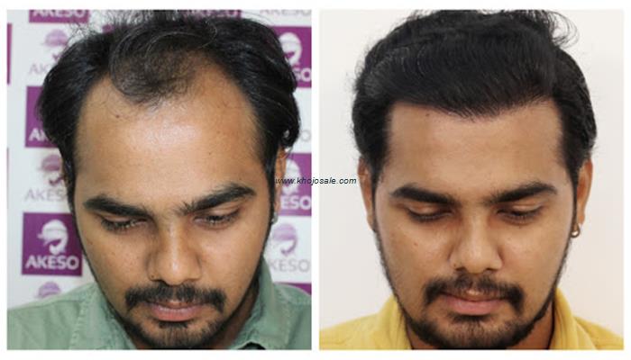 AKESO Hair Transplant